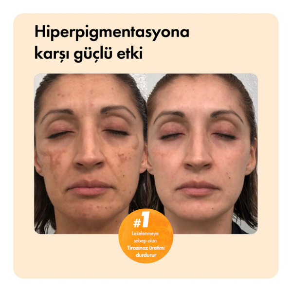 Kojik Asit Etkili Leke Karşıtı Bar